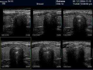 Thyroid, MSV