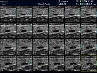 Thyroid mass, MSV