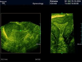 Uterus, OVIX & 3D