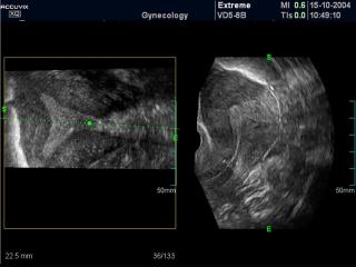 Uterus - oblique view, B-mode