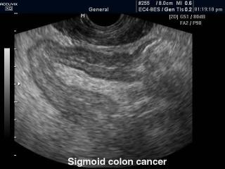 Sigmoid colon cancer, B-mode