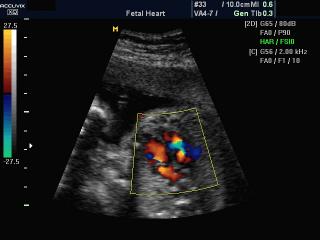 Fetal heart, color doppler