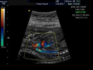 Fetal heart - aortic arch, color doppler