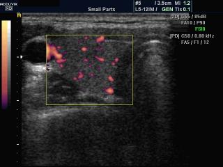 Thyroid, power doppler