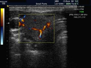 Thyroid, directional power doppler