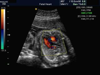 Fetal heart - LVOT, color doppler