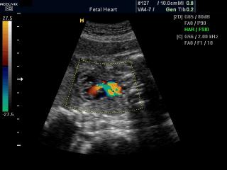 Fetal heart - RVOT, color doppler