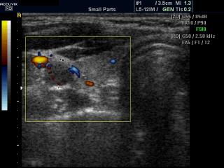 Thyroid and common carotid artery, power doppler