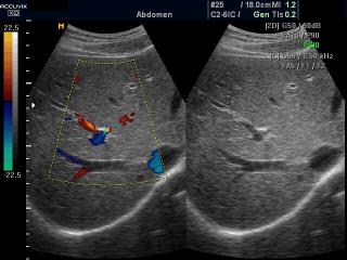 Liver blood flow, color doppler