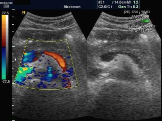 Blood flow in epigastrio, color doppler