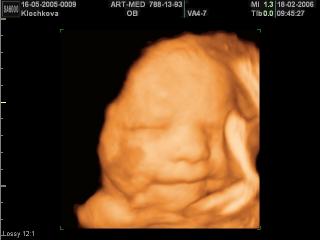 Fetal face and photo of baby, 3D