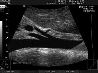 Abdominal aorta, B-mode