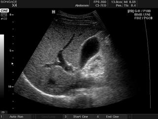 Liver and gallbladder, B-mode