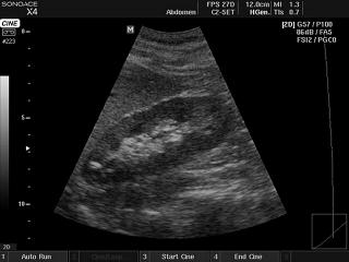 Kidney, B-mode