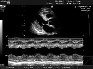 Heart - amyloidosis, M-mode