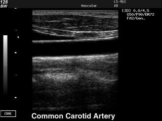 Common carotid artery, B-mode