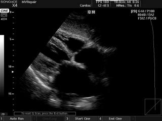 Heart (subcostal view), B-mode