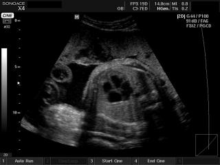 Fetus - heart, B-mode
