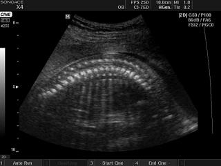 Fetus - spine, B-mode