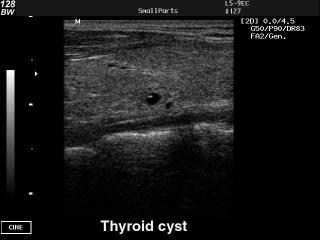 Thyroid cyst, B-mode