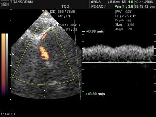 Medial cerebral artery, PD & PW