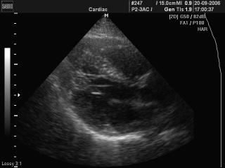 Additional muscles trabecula of LV, B-mode