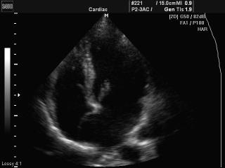 Aneurismus interatrium septum, B-mode