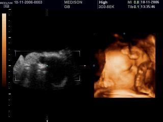 Fetal face and umbilical cord, 3D