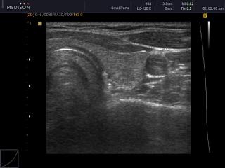 Thyroid, B-mode