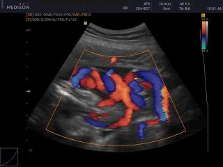 Umbilical cord, color doppler