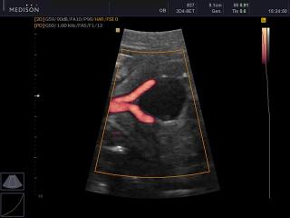 Artery of umbilical cord, power doppler