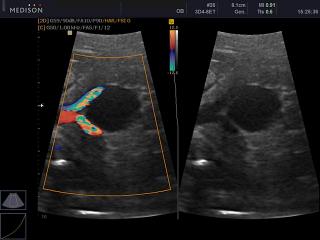 Artery of umbilical cord, directional power doppler