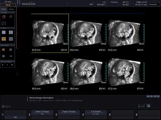 Fetal brain, MSV