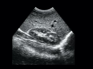 Liver cysts, B-mode