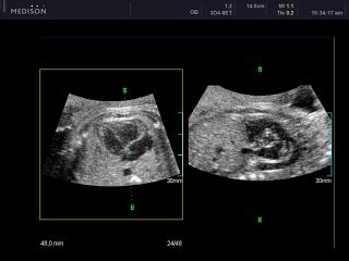 Fetal heart - oblique view, B-mode