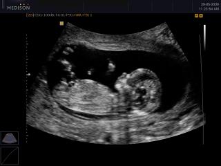 Fetus - 12 weeks, B-mode