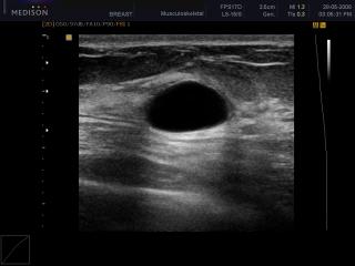 Breast - cyst, DMR