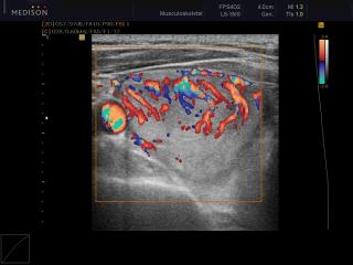 Thyroid nodule, color doppler