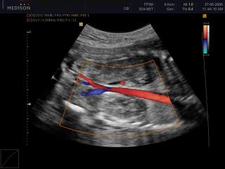 Aorta, color doppler