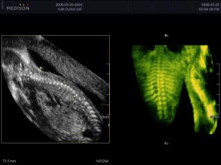 Fetal spine, OVIX & 3D