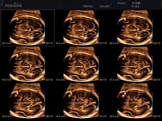 Fetal brain, MSV