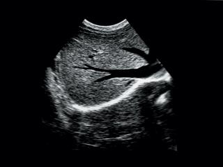 Liver and hepatic veins, B-mode