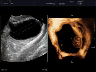 Ovarian mass, OVIX, 3D