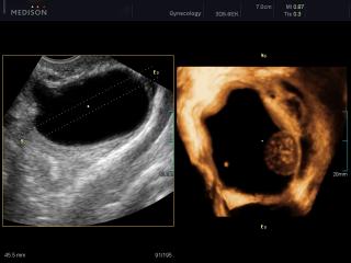 Ovarian mass, OVIX