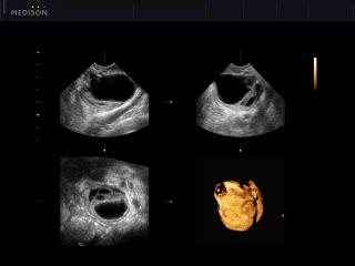 Ovarian cyst, inversion 3D