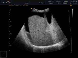 Liver ascites, B-mode