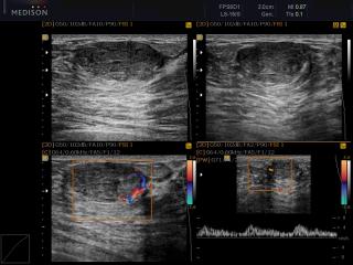 Breast mass, four-window view