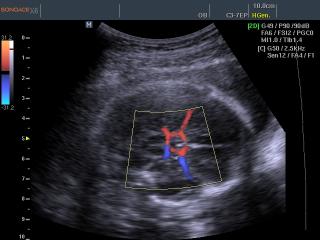 Circle of Willis, color doppler