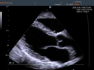 Heart (long axis of LV), B-mode