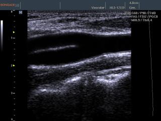 Common carotid artery - bifucation, B-mode